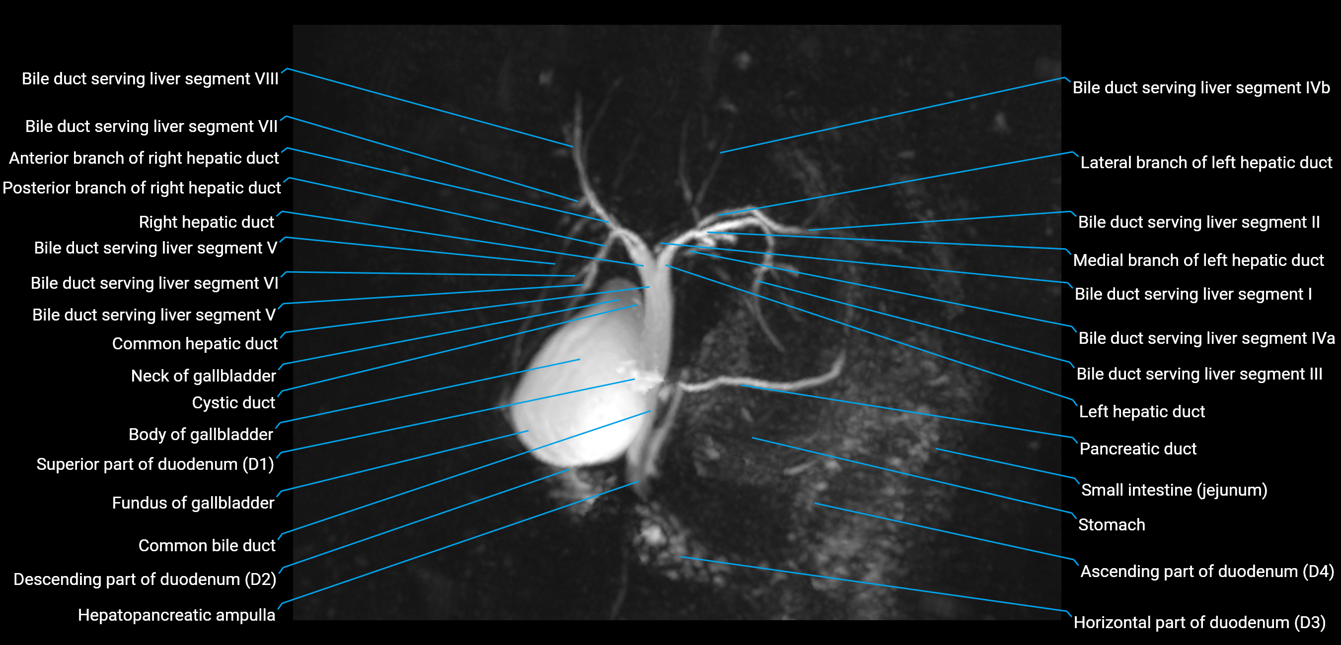 MRCP MIP MRI  anatomy labelled image-img-01003-00015.png